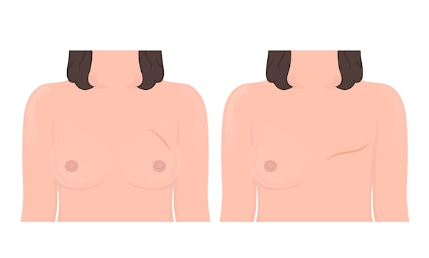 Mastectomy breast cancer lymph node surgery