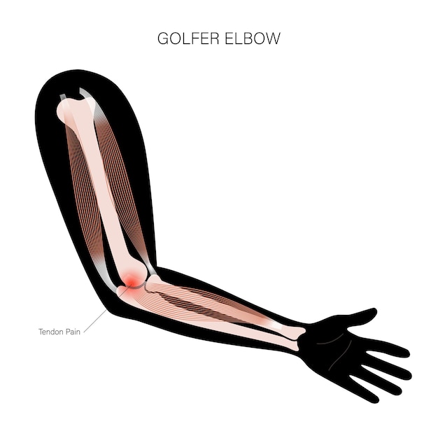 Medial epicondylitis golfer elbow