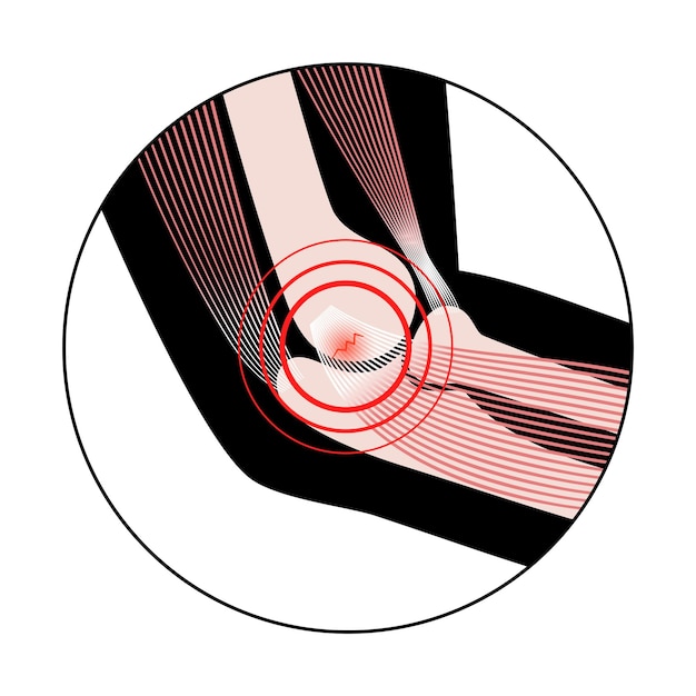 Medial epicondylitis golfer elbow