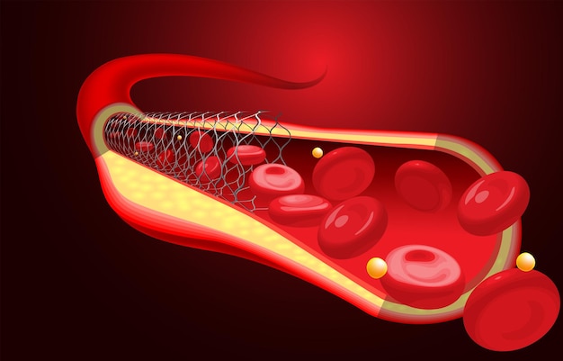 Medical and educational illustrations of the stent already placed