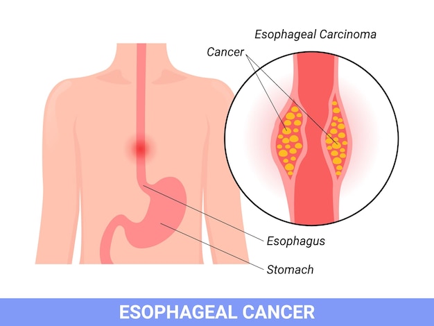 Medical illustration of the symptoms of esophageal carcinoma