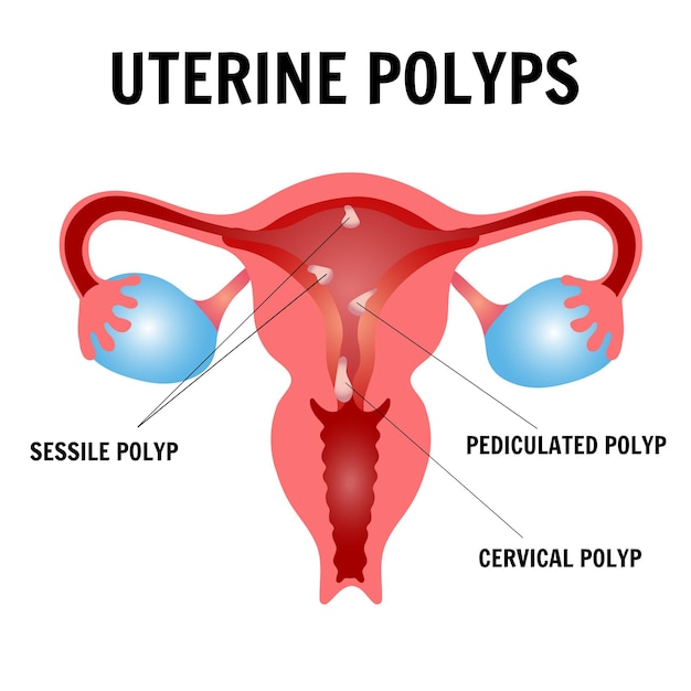 Medical science types of uterine polyps disease in vector illustration