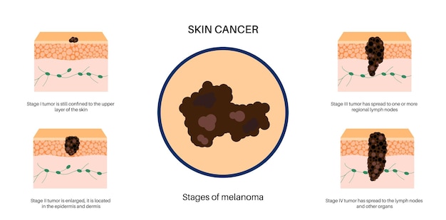 Vector melanoma stages poster