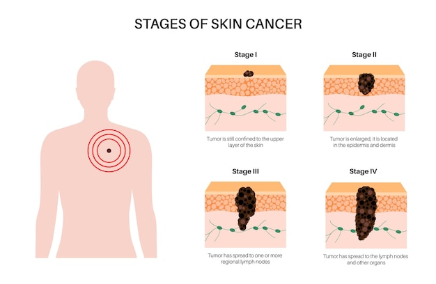 Vector melanoma stages poster