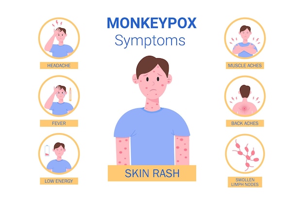 Monkey pox outbreak Infographics of virus symptoms in humans Vector illustration