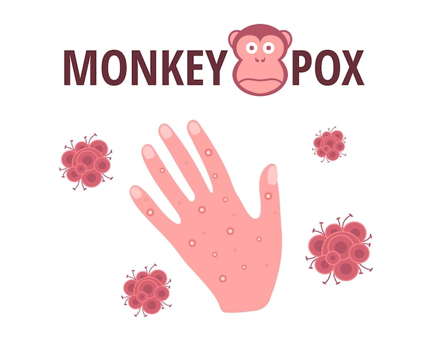 Monkey pox virus Vector design with skin rash on the hand symptom of an infectious disease