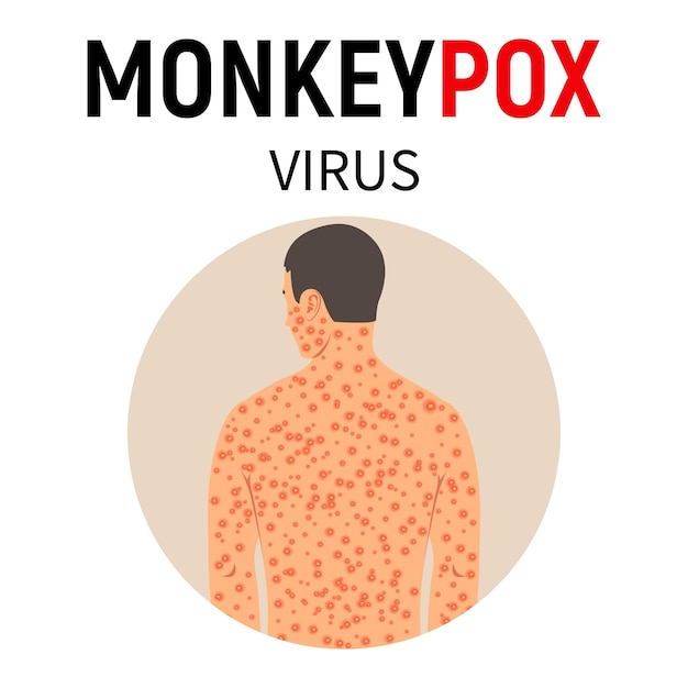 Monkeypox virus A man with monkeypox with a rash all over his body Disease symptoms Viral