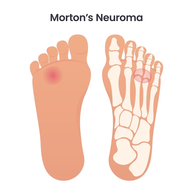 Morton's Neuroma medical educational vector illustration graphic