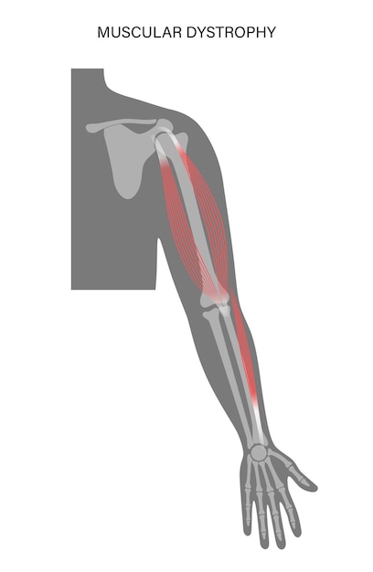 Muscular dystrophy of arm