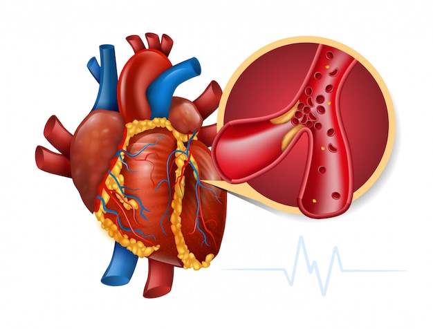 Myocardial infarction