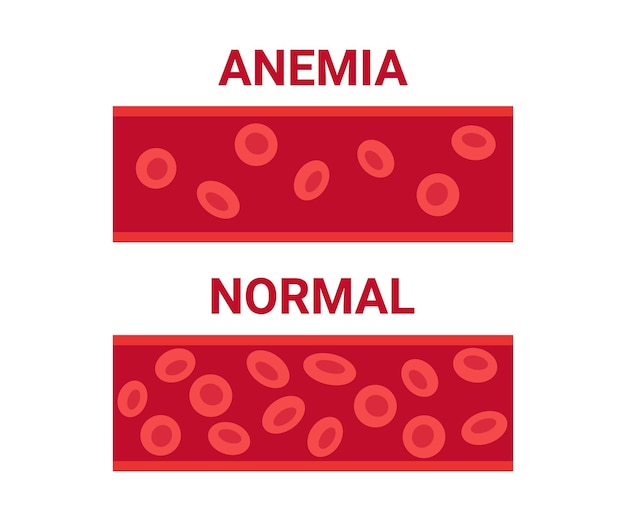 Normal, anemia blood in vessel comparison number circulation cells erythrocyte. Hemoglobin low level