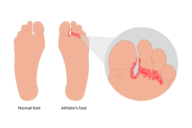 Vector normal and athletes foot