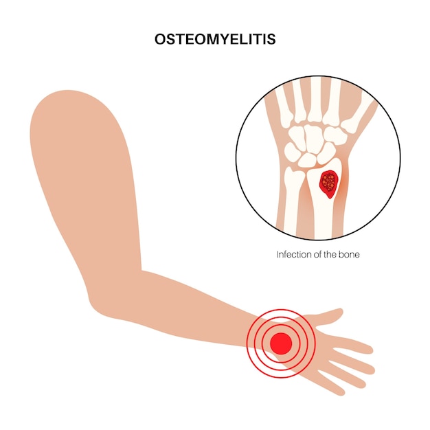 Osteomyelitis disease Infected arm bones pain and overlying redness Infection spreads through the bloodstream into the wrist Staphylococcus aureus bacteria in the human body vector illustration