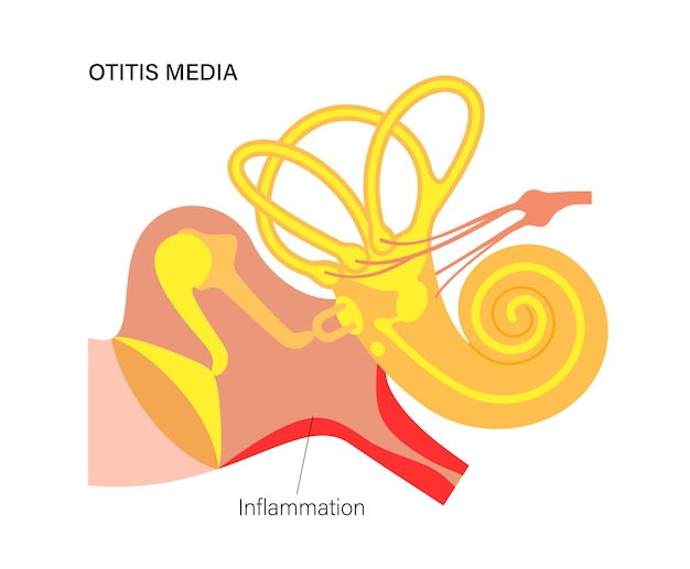 Otitis media disease