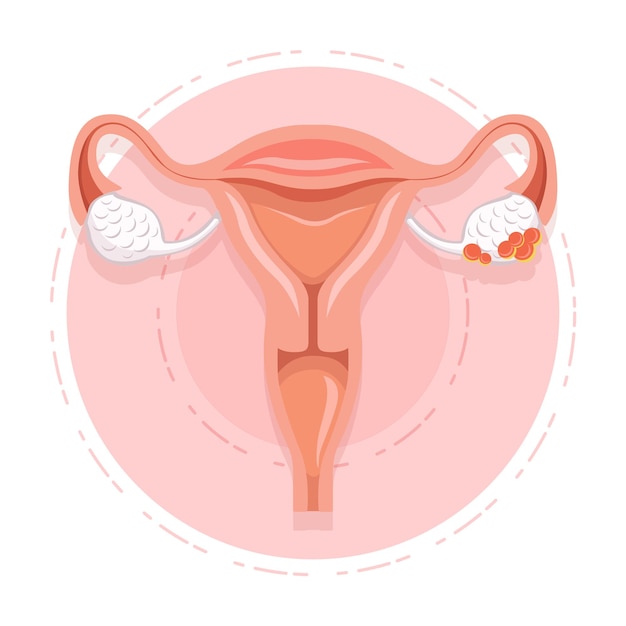 Ovary Cancer Vector Women's Health