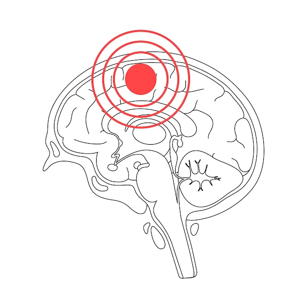 Vector pain brain illustration