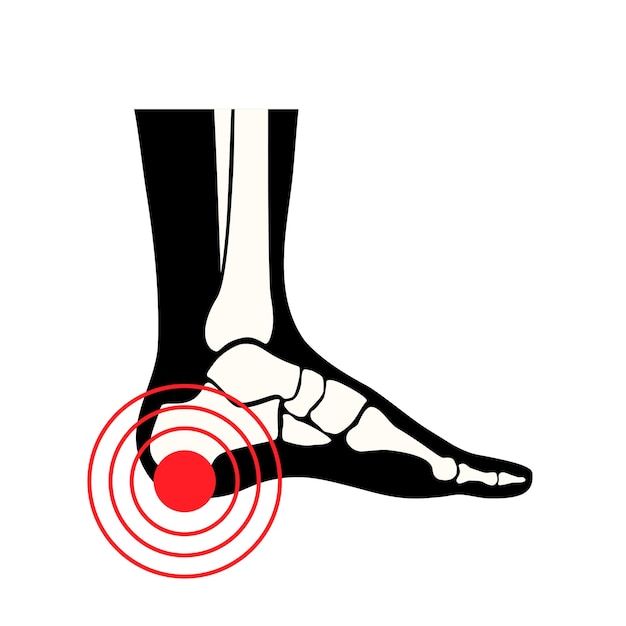 Vector pain of the heel anatomical poster ankle and foot diseases calcaneal spur achilles tendinitis plantar fascia strain or fasciitis treatment ankle bones and ligament medical vector illustration