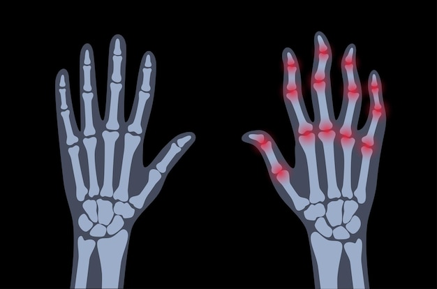 Pain and inflammation in hand on x ray. Rheumatoid arthritis symptom on human joints