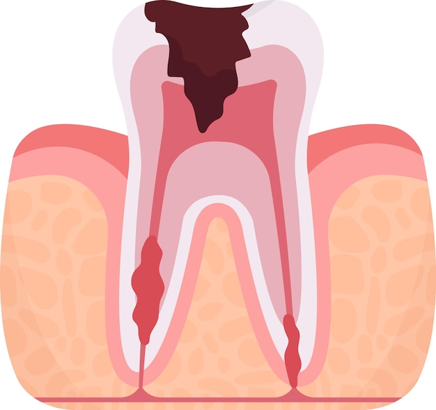 Periodontitis Tooth Problem