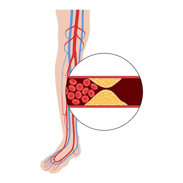 Peripheral artery disease