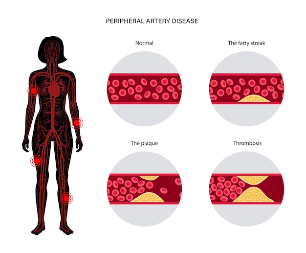 Peripheral artery disease