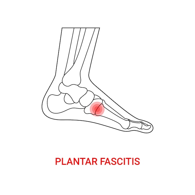 Plantar fascitis medical design with line style