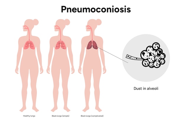 Vector pneumoconiosis healthy and black lungs