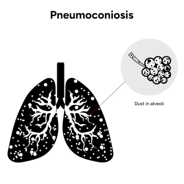 Vector pneumoconiosis lung icon version