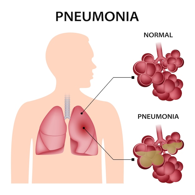 Pneumonia concept