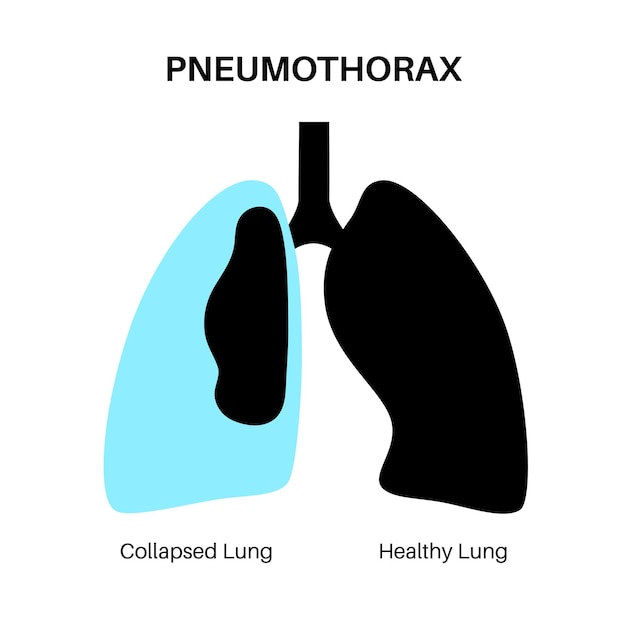 Pneumothorax anatomical poster