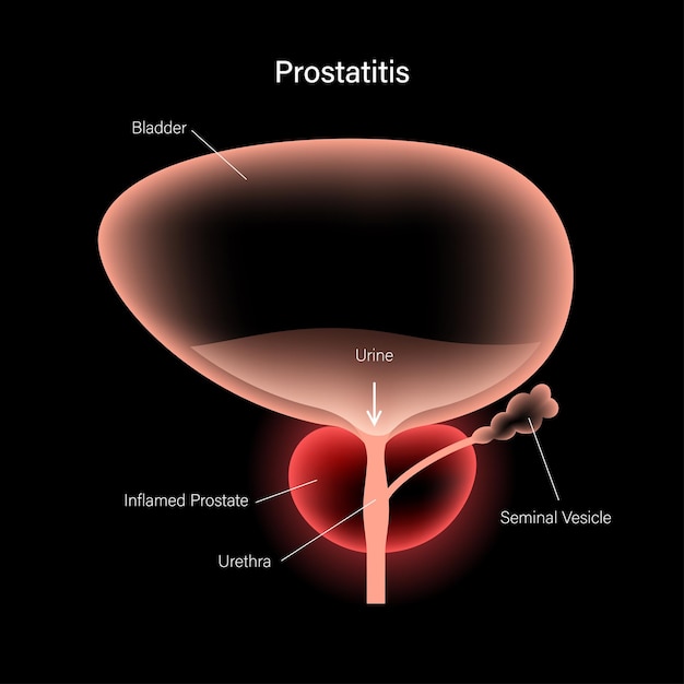 Prostatitis inflammation problem