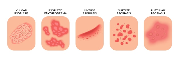 Psoriasis Allergic eczema types rashes treatment Dermatology infectious spots skin disease Epidermis infection problems recent vector concept