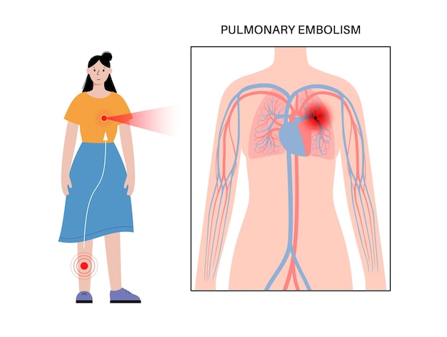 Pulmonary embolism disease