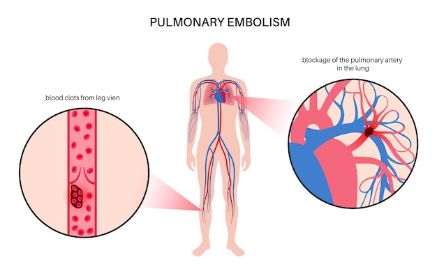 Pulmonary embolism disease