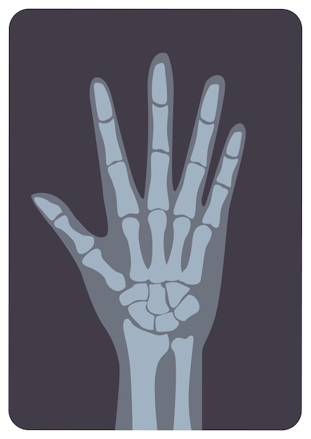 Radiograph, X-radiation picture or X-ray image of hand or palm with wrist and fingers