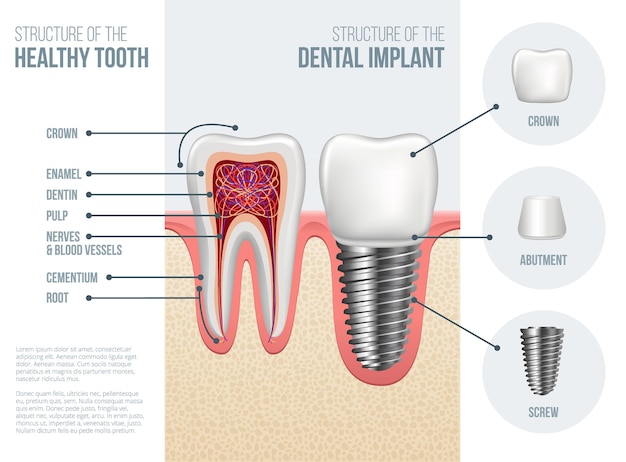 Realistic healthy tooth with caries and dental implant structure with crown abutment screw