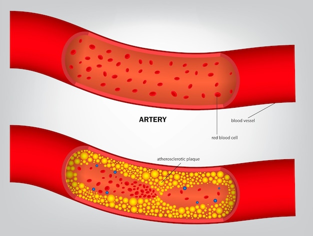 realistic type of cholesterol in artery isolated.