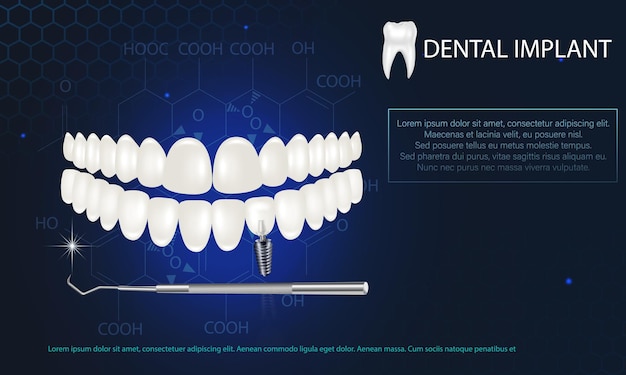 Realistic white dental implant on a blue background Vector 3d model of a tooth with a thread