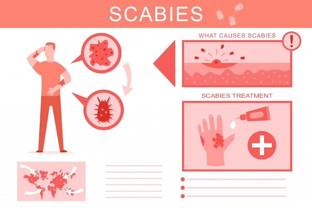 Scabies causes and treatment medical infographics vector cartoon illustration.