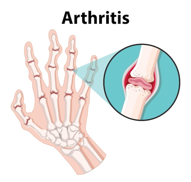 Science Education Human Anatomy and Arthritis Stages Infographic