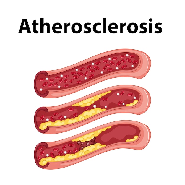 Science Education Human Anatomy and Atherosclerosis Infographic