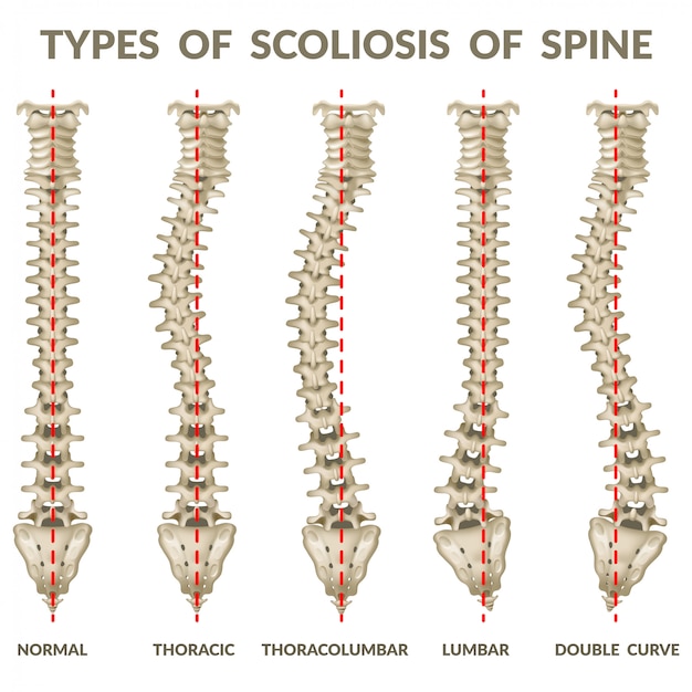 Scoliosis of spine