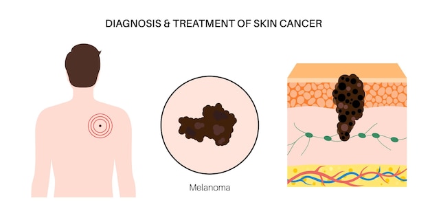 Vector skin cancer diagnosis