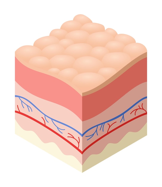 Skincare medical concept Problems in crosssection of human skin horizontal layers structure Anatomy illustrative model unhealthly layer of skin