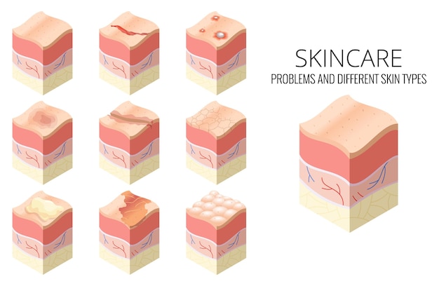 Skincare medical concept Set of problems of different skin types in crosssection of human skin horizontal layers structure