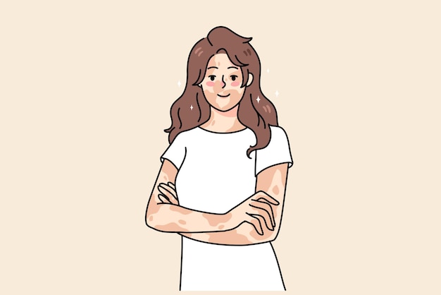 Smiling young woman with skin disease feel body positive. Happy girl on vitiligo international day. Depigmentation day. Skincare problem concept. Flat vector illustration.