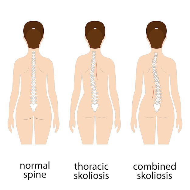 Spine deformation types and healthy spine comparison diagram poster with backbone curvatures Female