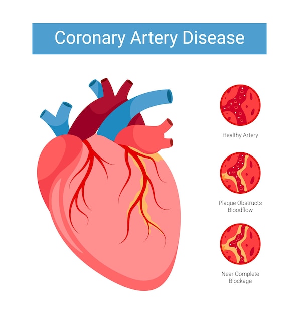 Stages of Coronary Artery Disease CAD