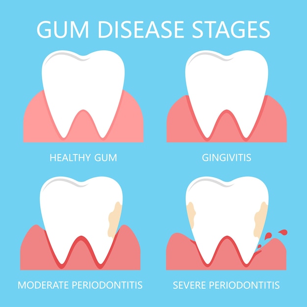 Stages of gum disease the stage of development of dental periodontitis