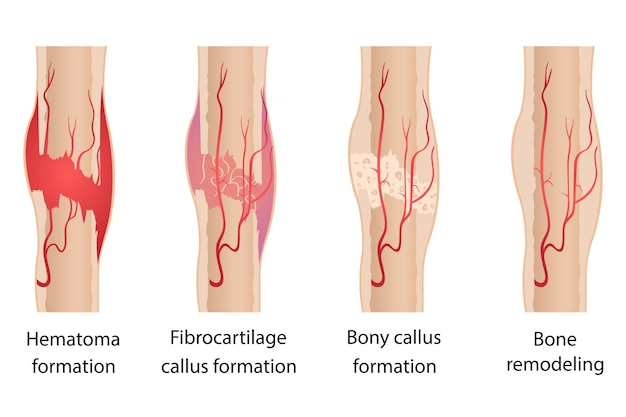 Stages of healing of bone fractures